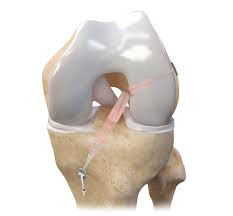 ACL Reconstruction