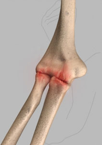 Arthritis of the Elbow