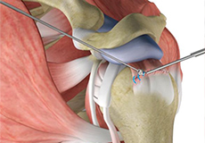 Arthroscopic Rotator Cuff Repair