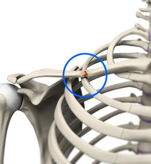 Clavicle Fracture