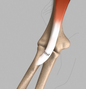 Distal Biceps Tendon Repair