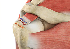 Failed Rotator Cuff Repair Treatment