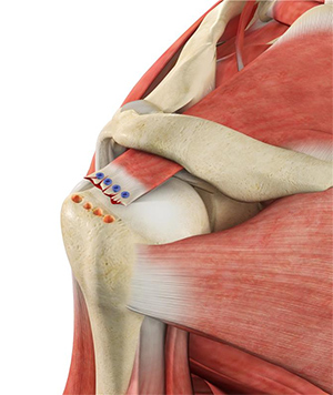 Failed Rotator Cuff Repair Treatmen