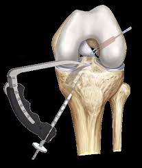 ACL Reconstruction Patellar Tendon