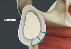 Labral Repair/Shoulder Instability Surgery