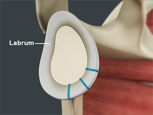 Labral Repair