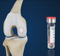 Matrix-induced Autologous Chondrocyte Implantation (MACI)