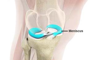 Meniscal Repair Surgery