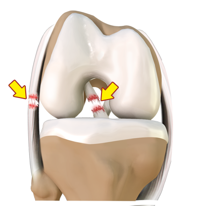 Multiligament Knee Injury