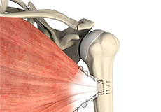 Pectoralis Major Tears/Repairs
