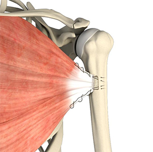 Shoulder Impingement