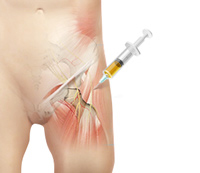 Platelet Rich Plasma Injection