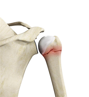 Shoulder Fracture