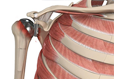 Revision Shoulder Replacement