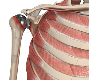 revision-shoulder-replacement