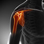 Reverse Shoulder Replacement