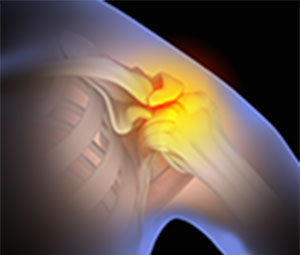 Shoulder Impingement