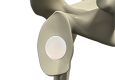 Total Shoulders with Inlay Glenoids