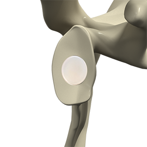 Total Shoulders with Inlay Glenoids