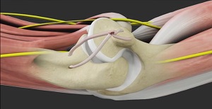 Medial Ulnar Collateral Ligament Tear, UCL Elbow Specialist